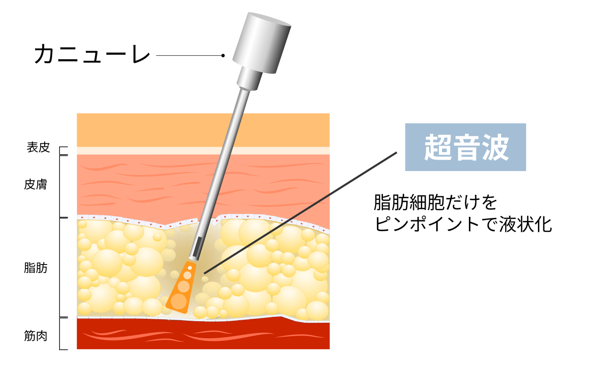 脂肪吸引 - 顔の脂肪吸引注射に特化した美容クリニック｜NYANCLI