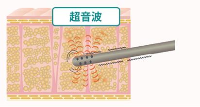 虫歯の進行度の画像