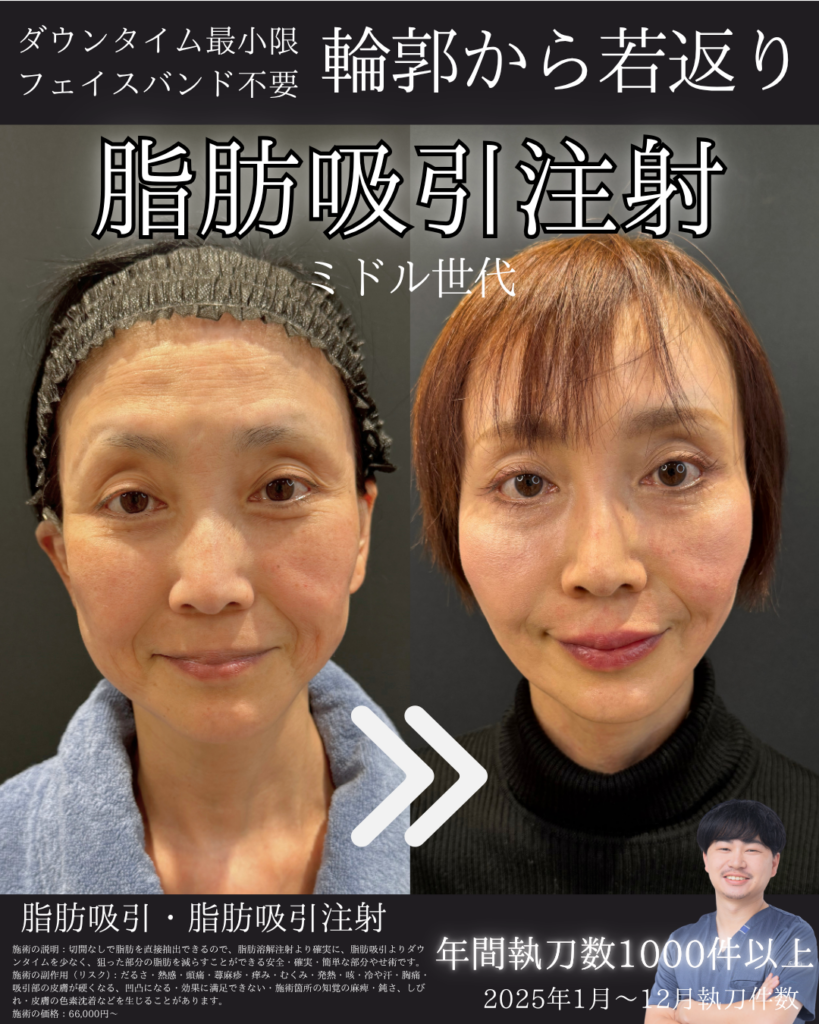 糸リフト併用症例１