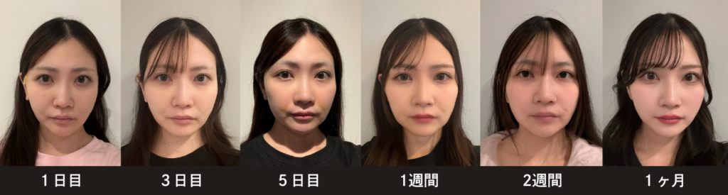 ダウンタイム経過