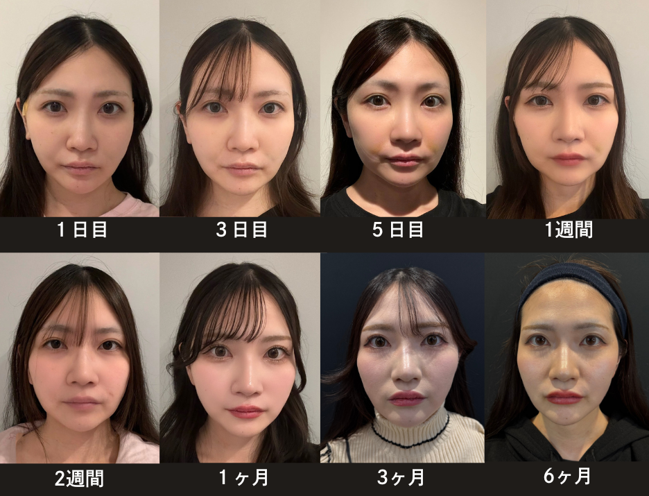 ダウンタイム経過