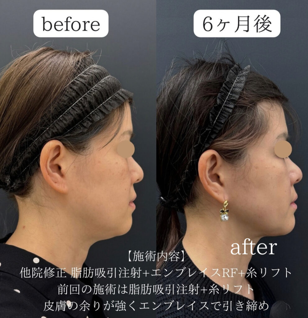 糸リフト併用症例写真
