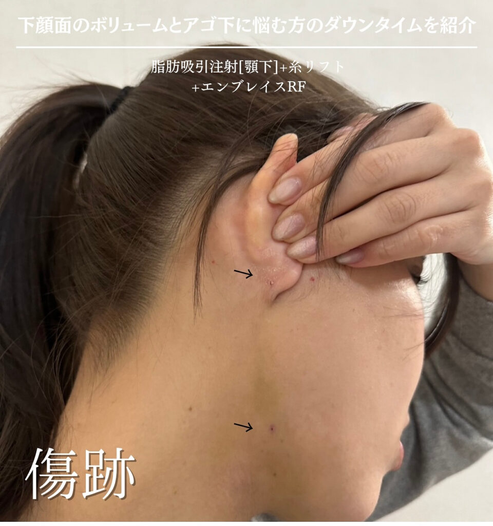 脂肪吸引注射_傷跡