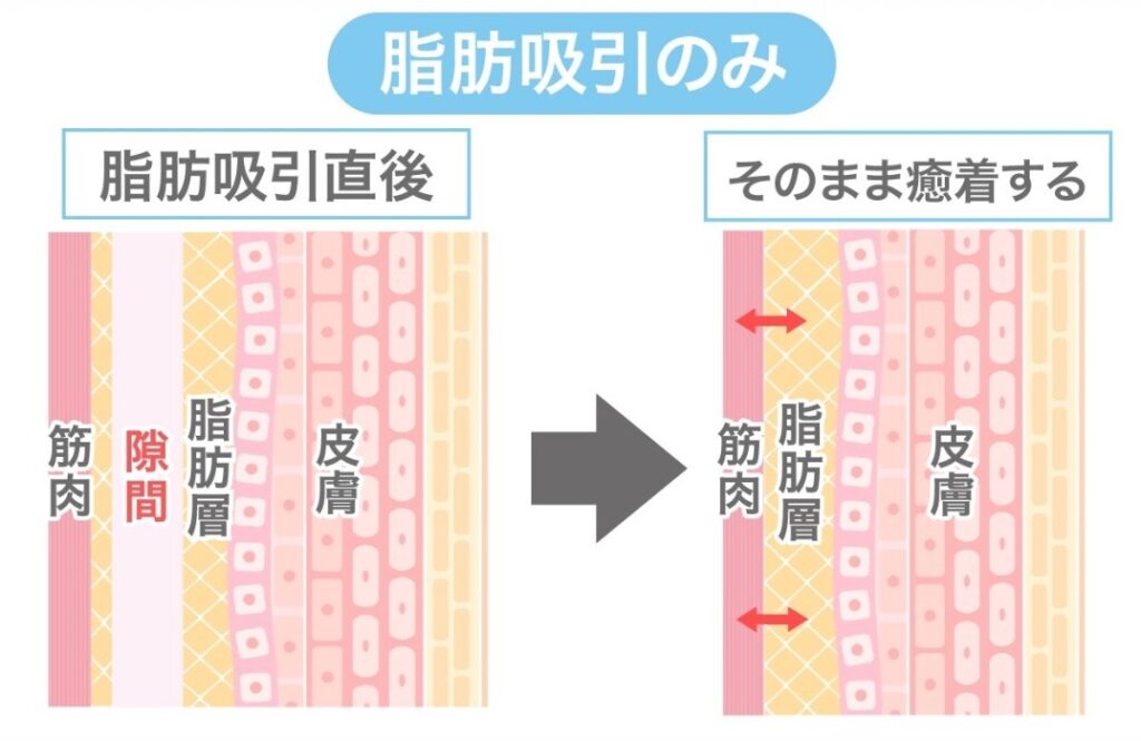 脂肪吸引図解
