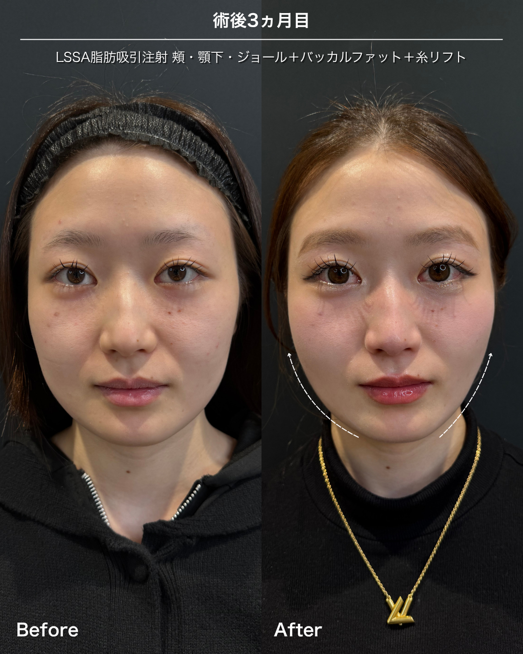 脂肪吸引注射(頬)の症例:施術前後の比較写真と傷跡