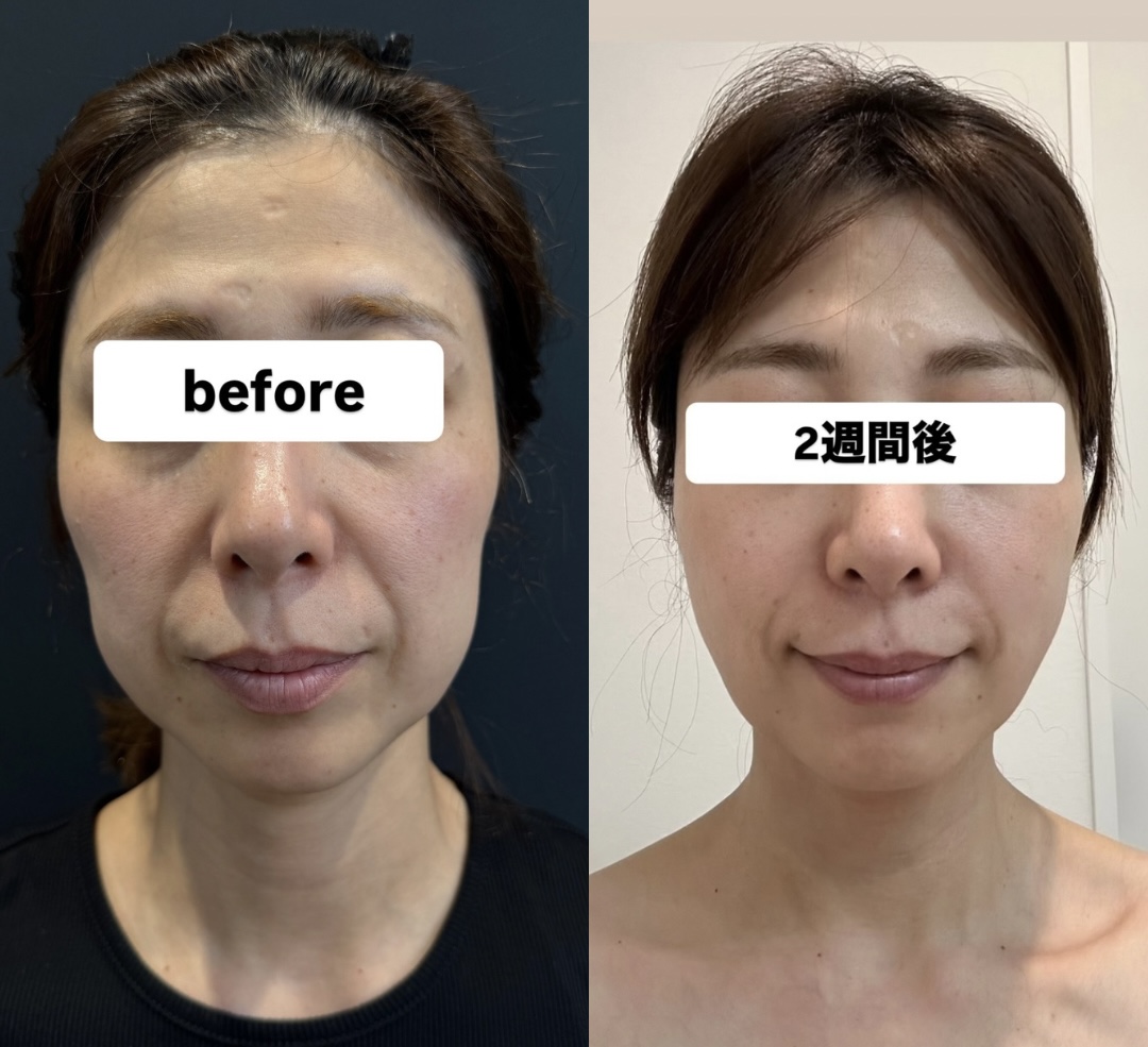 脂肪吸引注射+バッカル症例