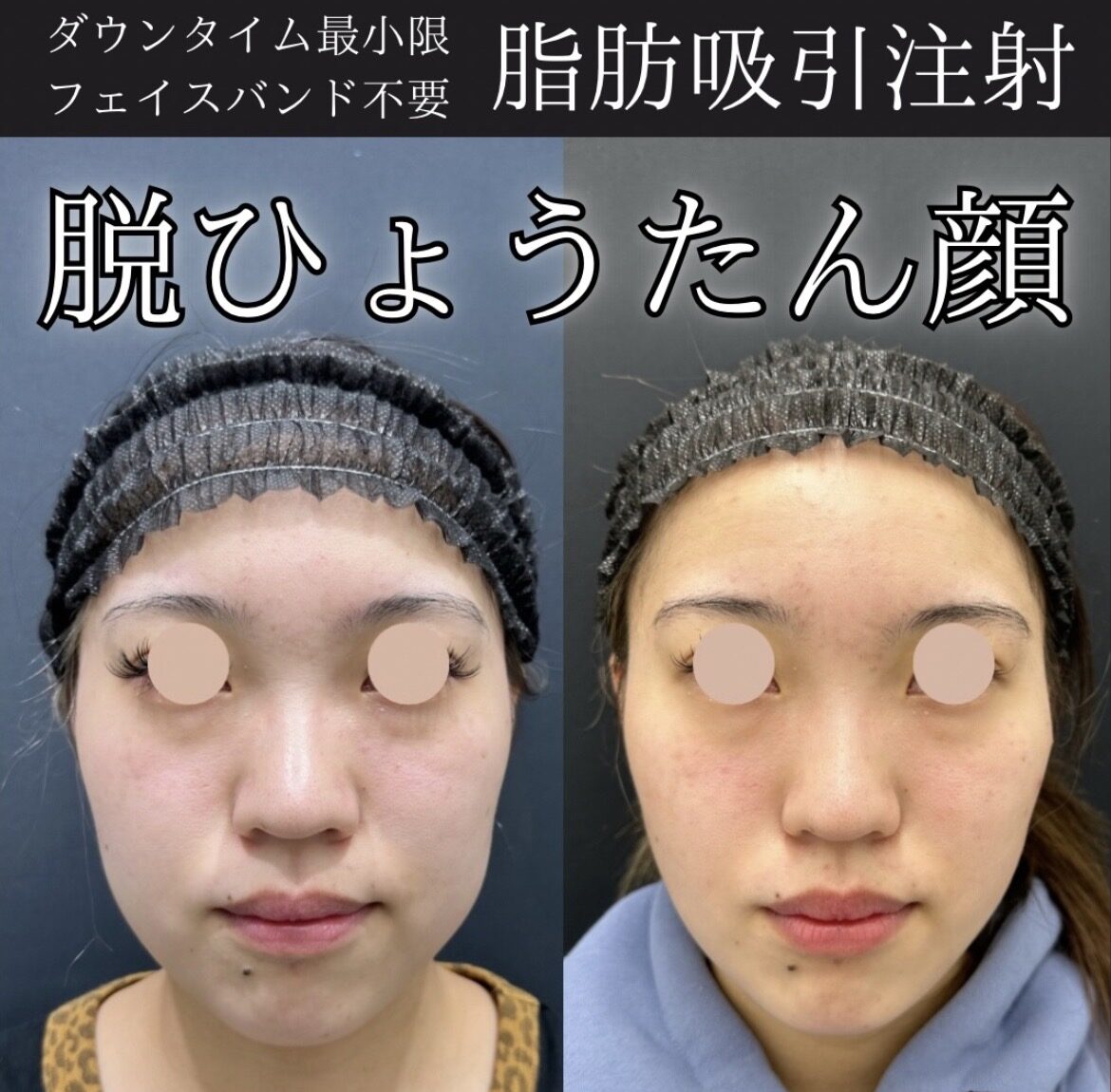 脂肪吸引注射(ジョールファット)の症例:施術前後の比較写真と傷跡