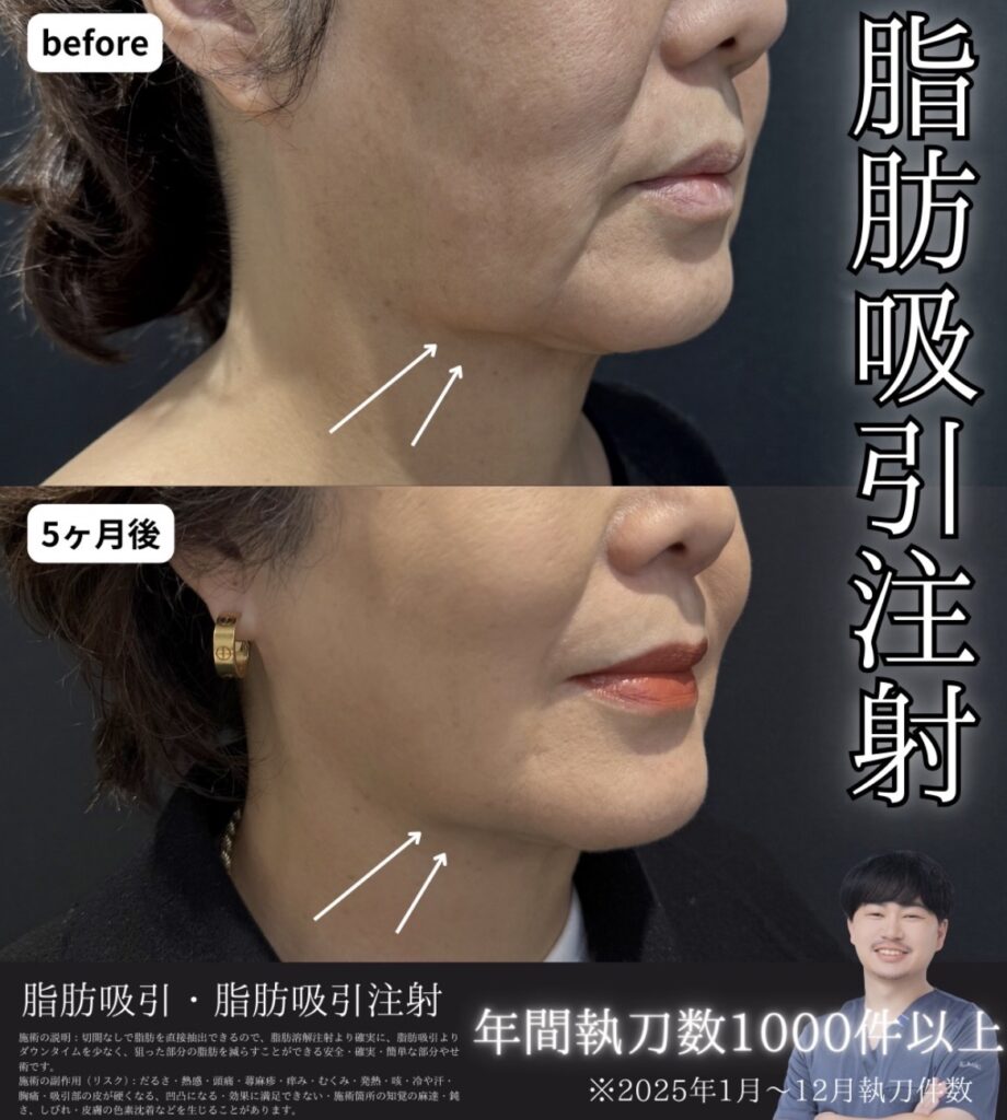 皮膚のたるみ