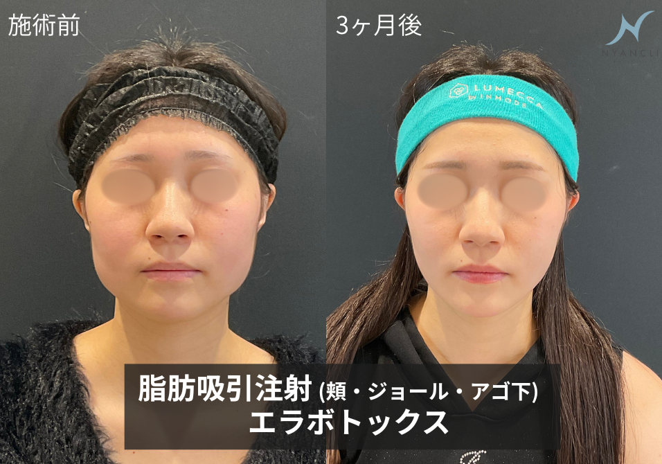 エラボトックス症例