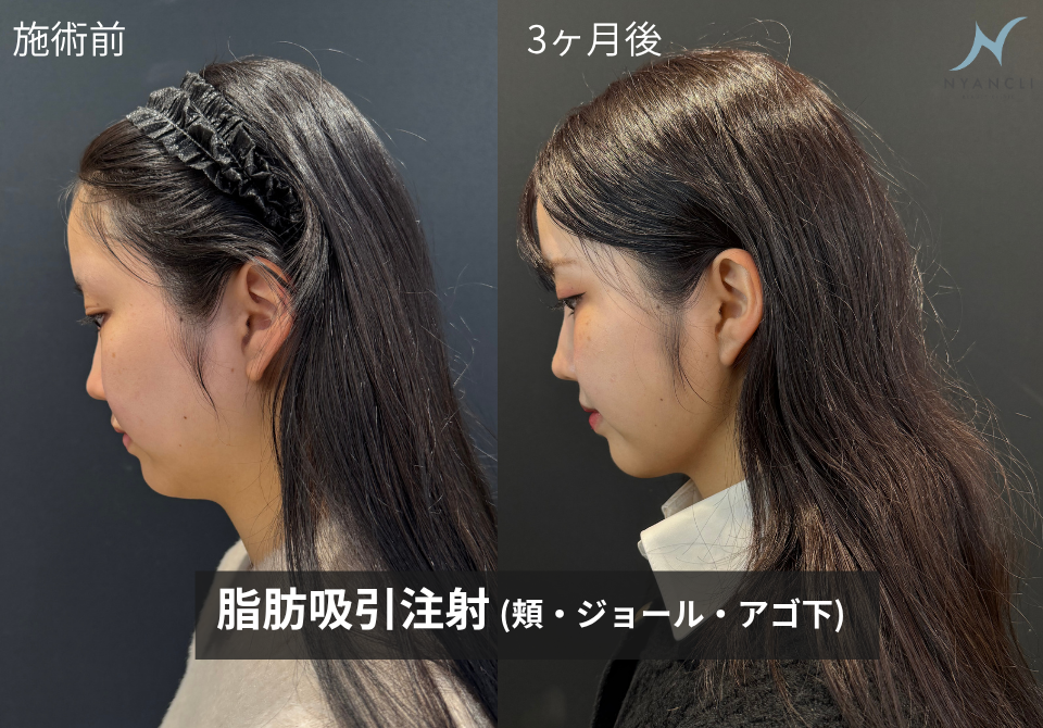 脂肪吸引注射症例
