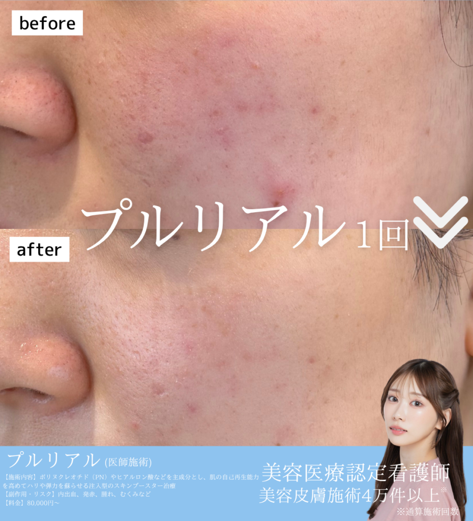プルリアル症例