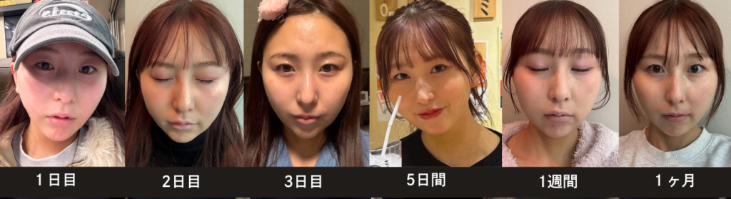 ダウンタイム経過