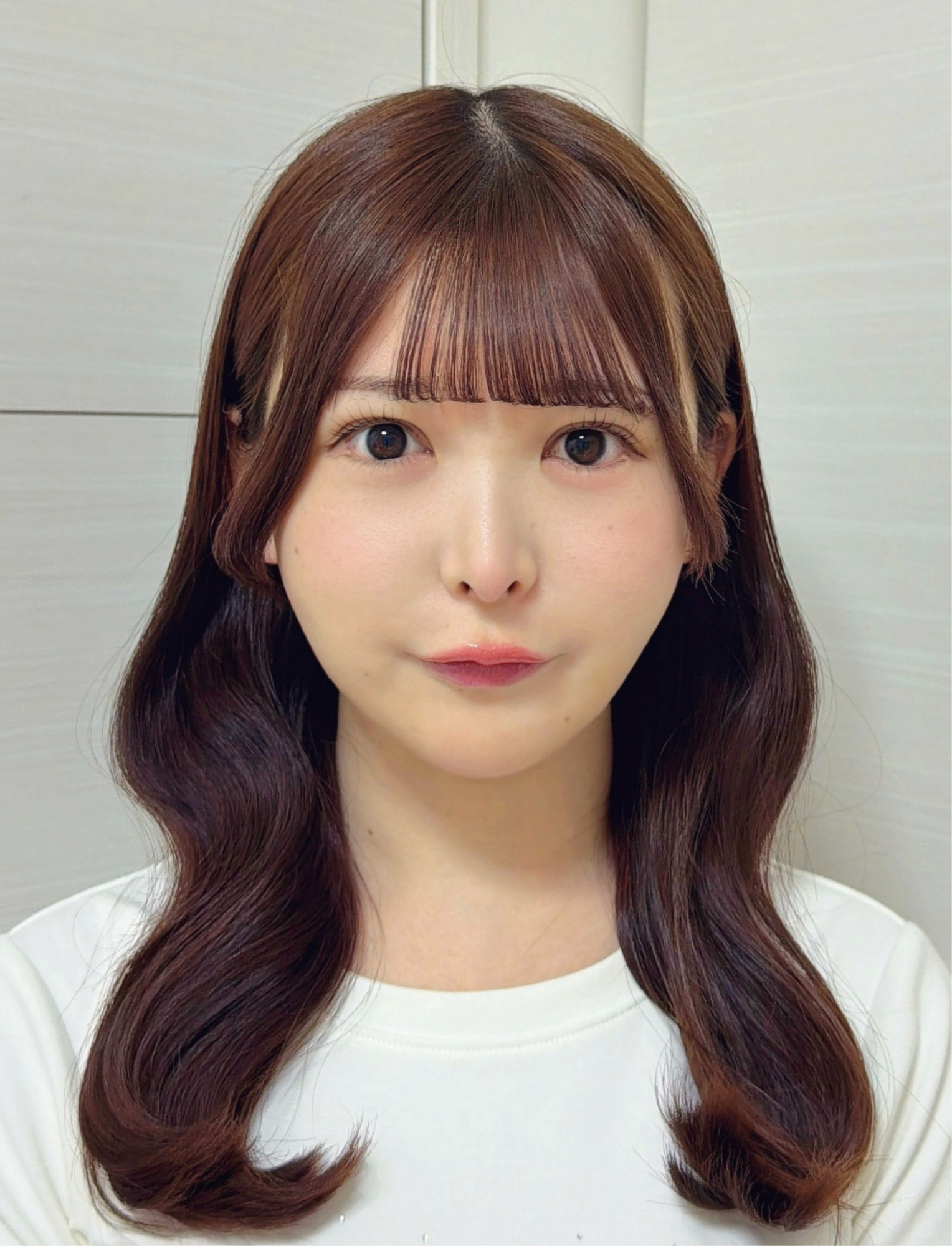 脂肪吸引注射(顔)の経過:術後1か月の症例写真と傷跡