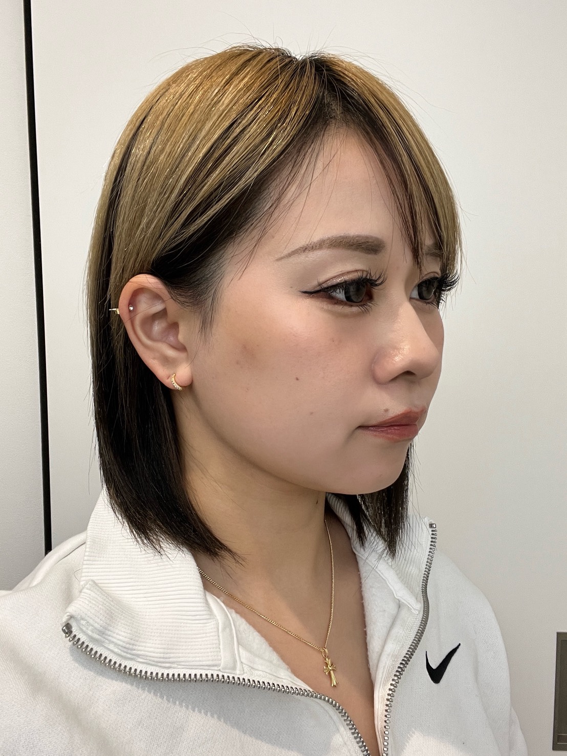 脂肪吸引注射(顔)の経過:施術後1か月の症例写真と傷跡