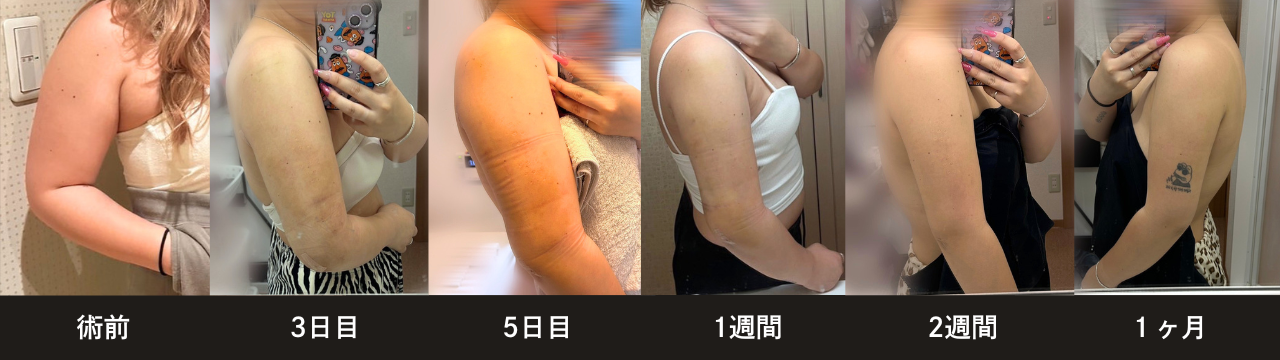 脂肪吸引注射(二の腕)のダウンタイム:腫れや皮膚のつっぱり感(拘縮)が現れることがある
