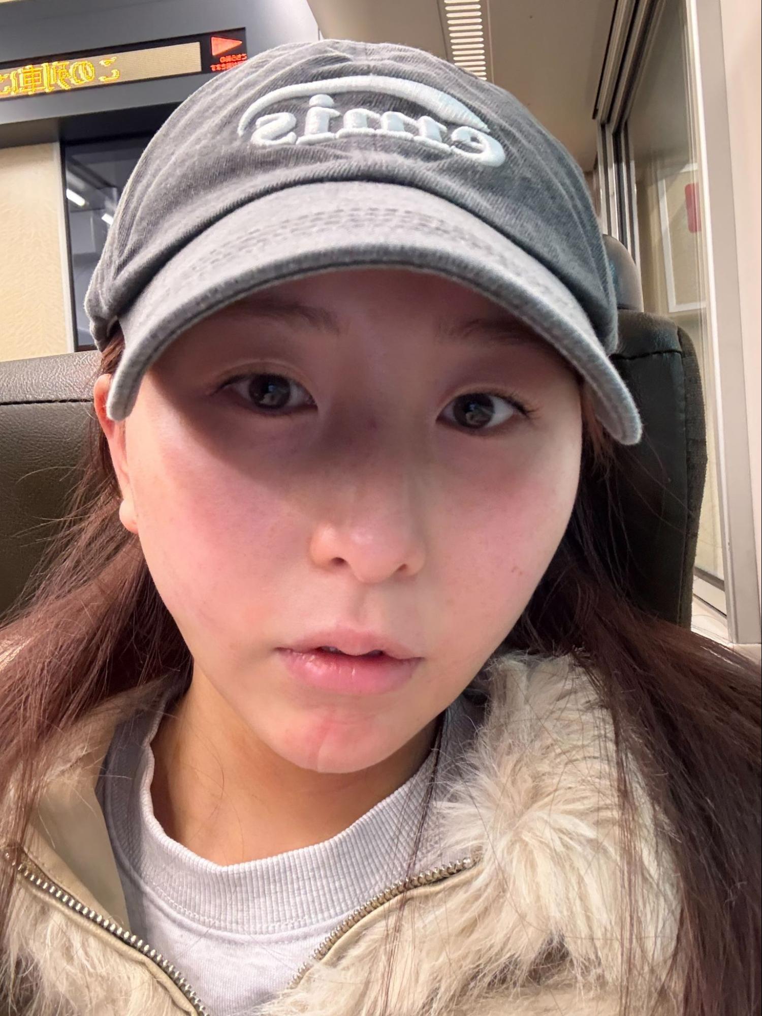 脂肪吸引注射(顔)の経過:術後1日目の症例写真と傷跡