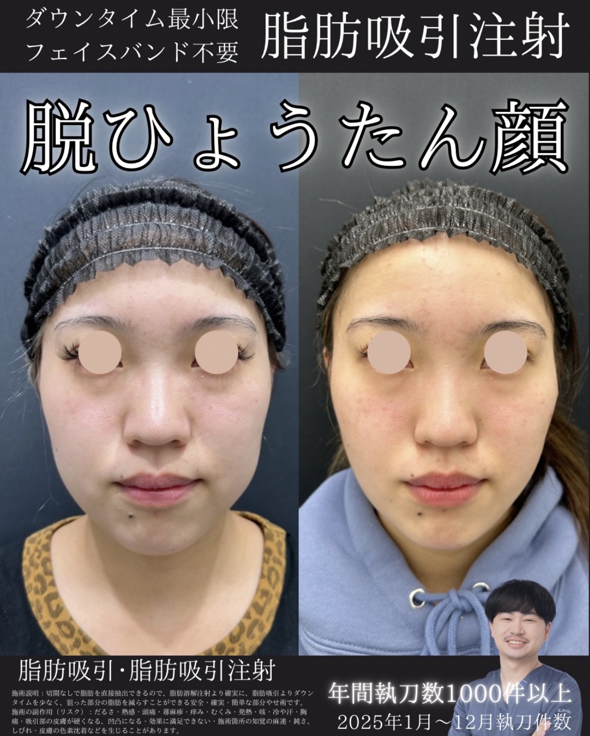 脂肪吸引注射(ジョールファット)の症例:施術前後の比較写真と傷跡