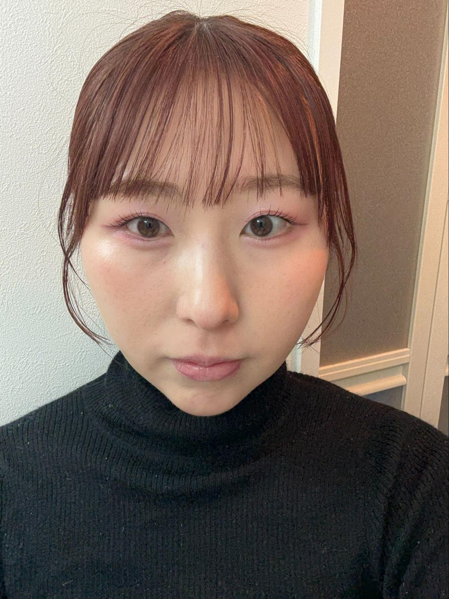 脂肪吸引注射(顔)の経過:術後5日目の症例写真と傷跡
