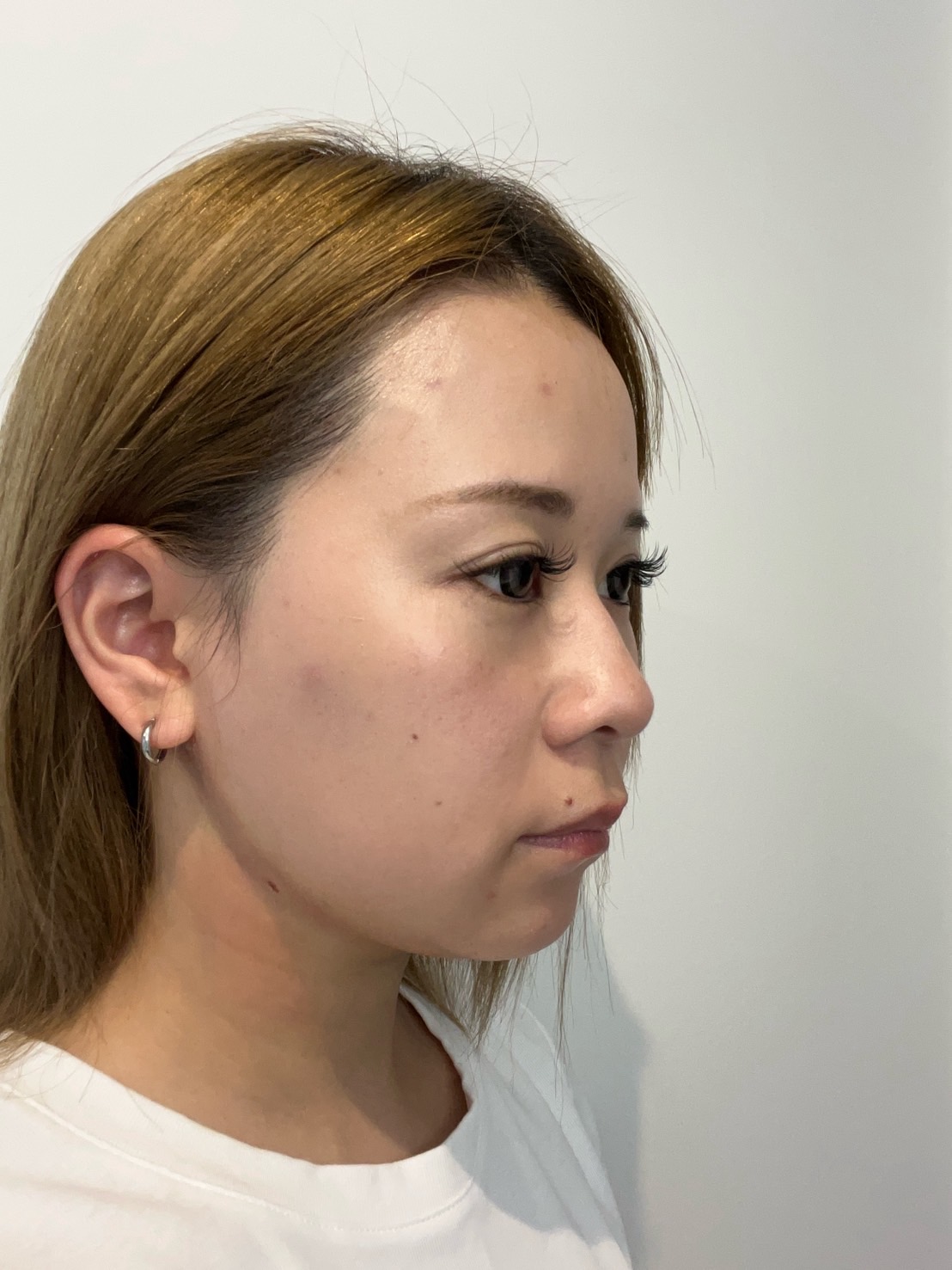 脂肪吸引注射(顔)の経過:施術後1日目の症例写真と傷跡