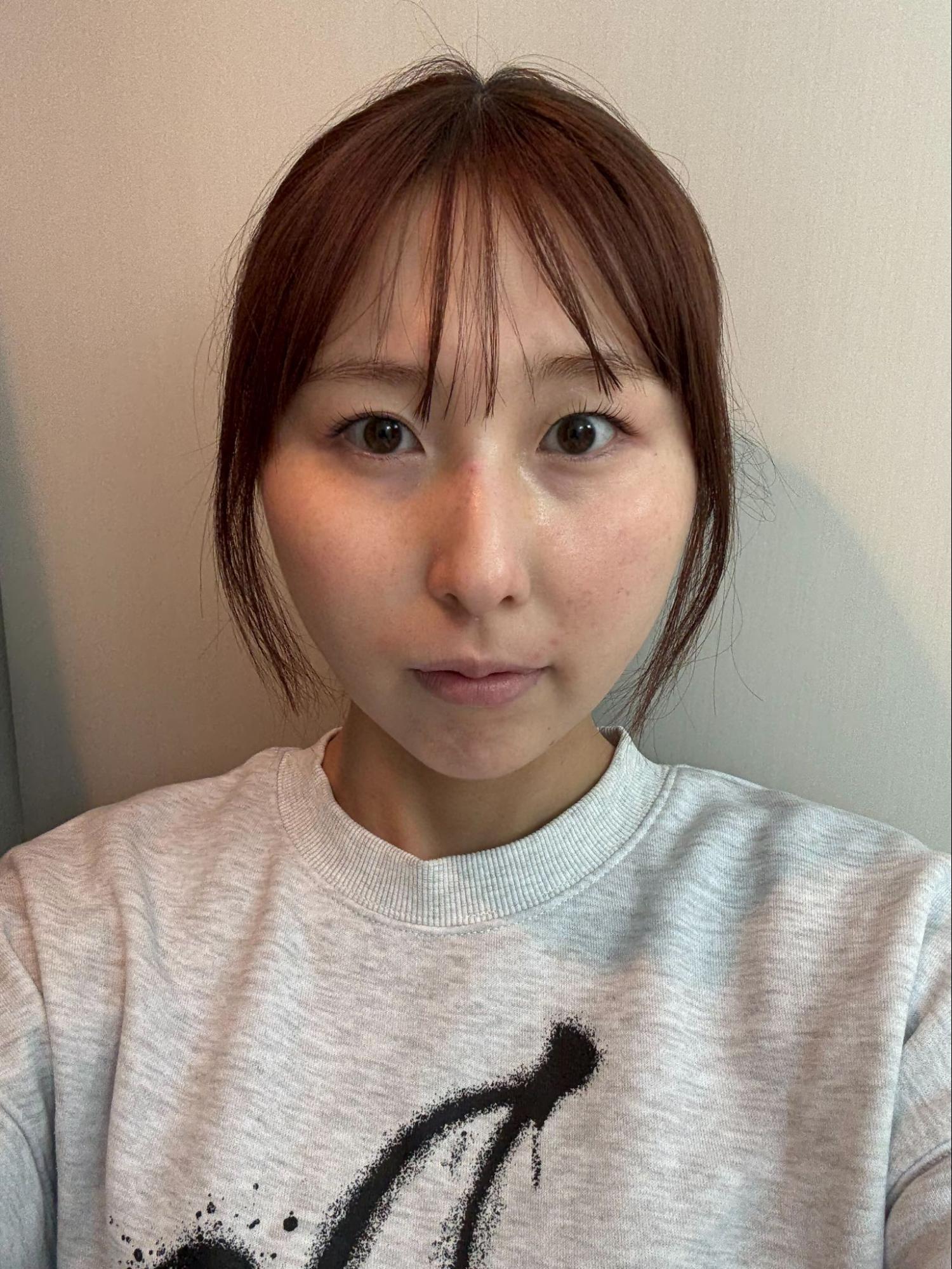 脂肪吸引注射(顔)の経過:術後2週間の症例写真と傷跡