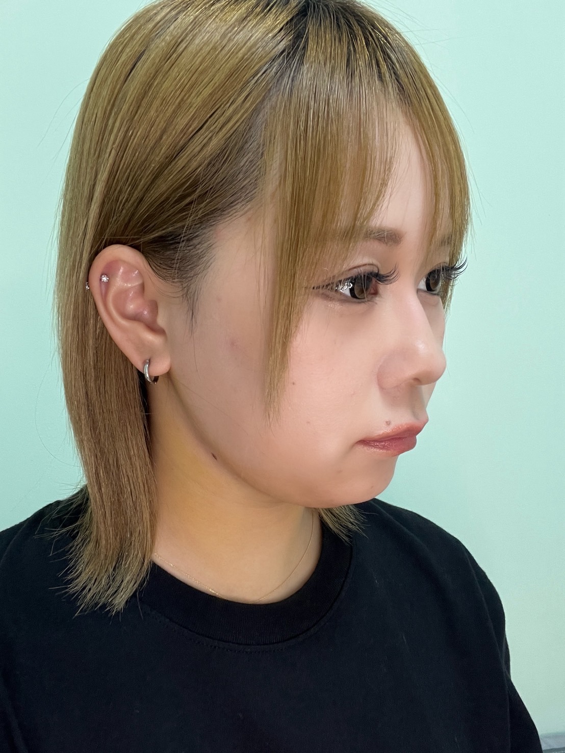 脂肪吸引注射(顔)の経過:施術後3日目の症例写真と傷跡