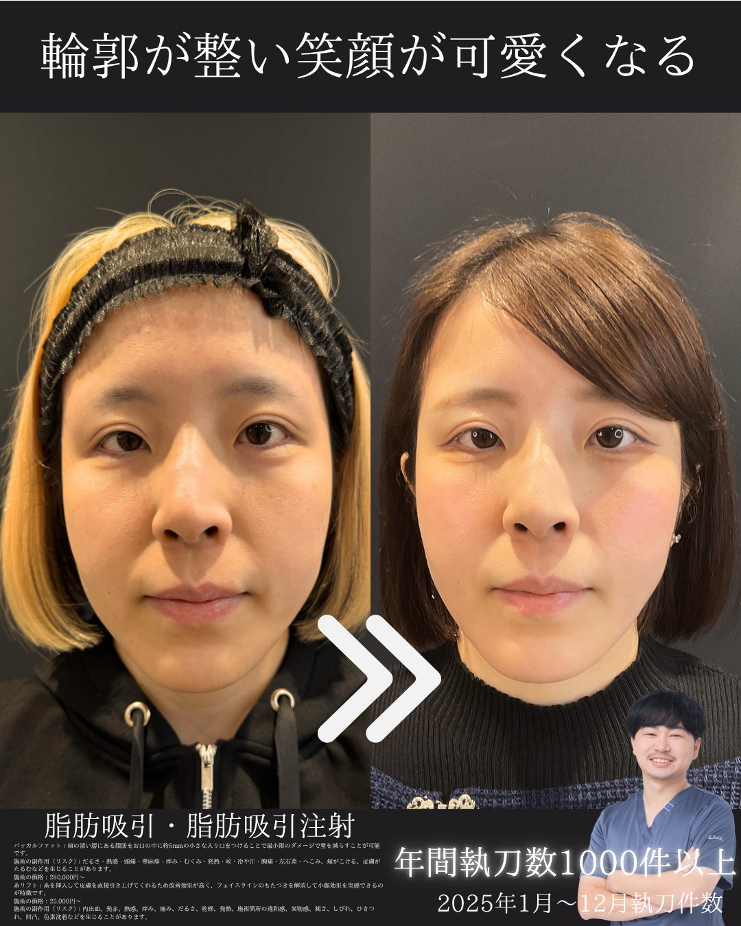 脂肪吸引注射(頬)の症例:施術前後の比較写真と傷跡
