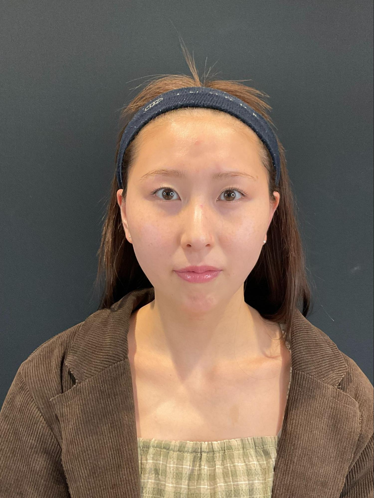 脂肪吸引注射(顔)の経過:術後3か月の症例写真と傷跡