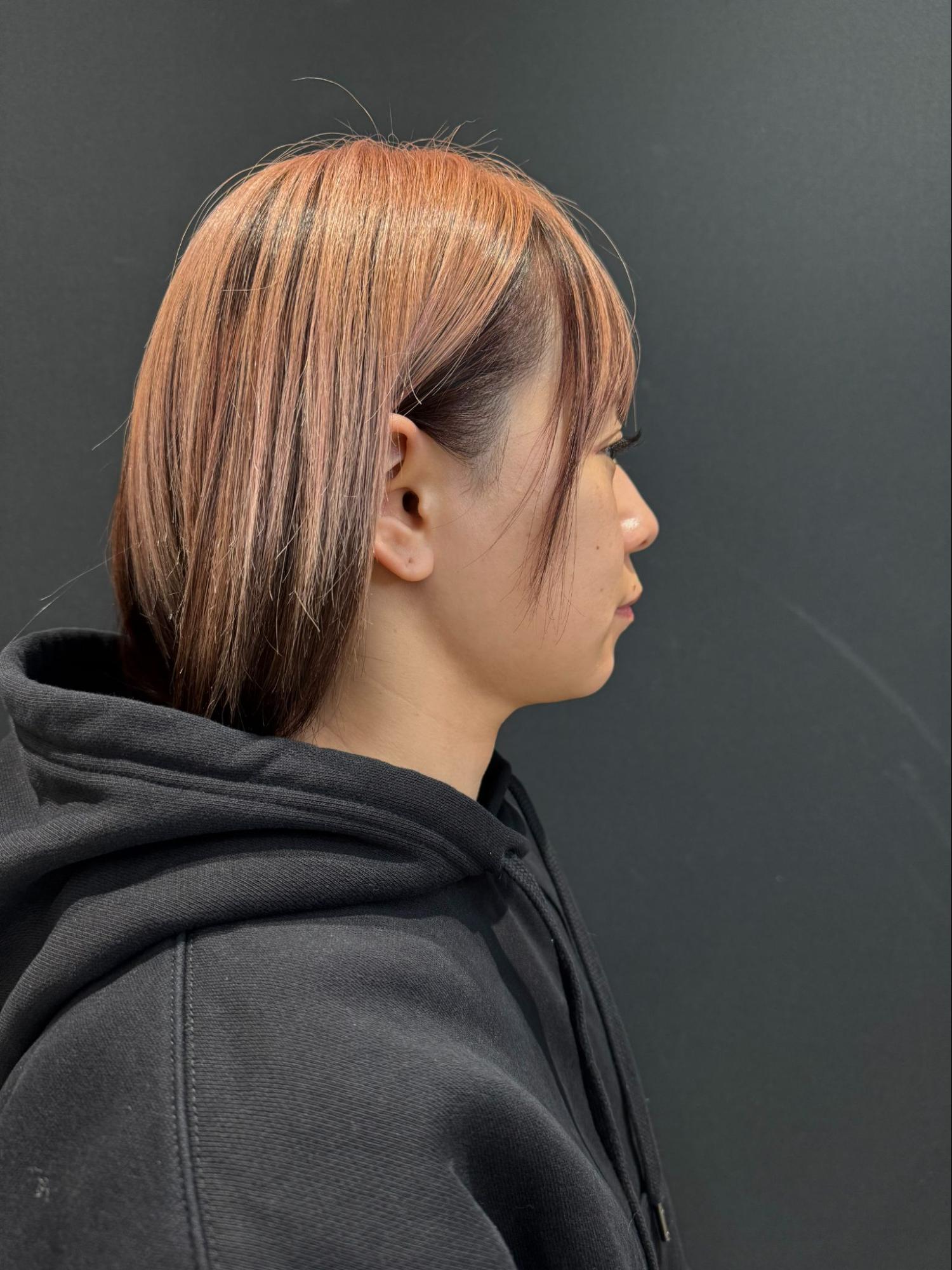 脂肪吸引注射(顔)の経過:施術後6か月の症例写真と傷跡