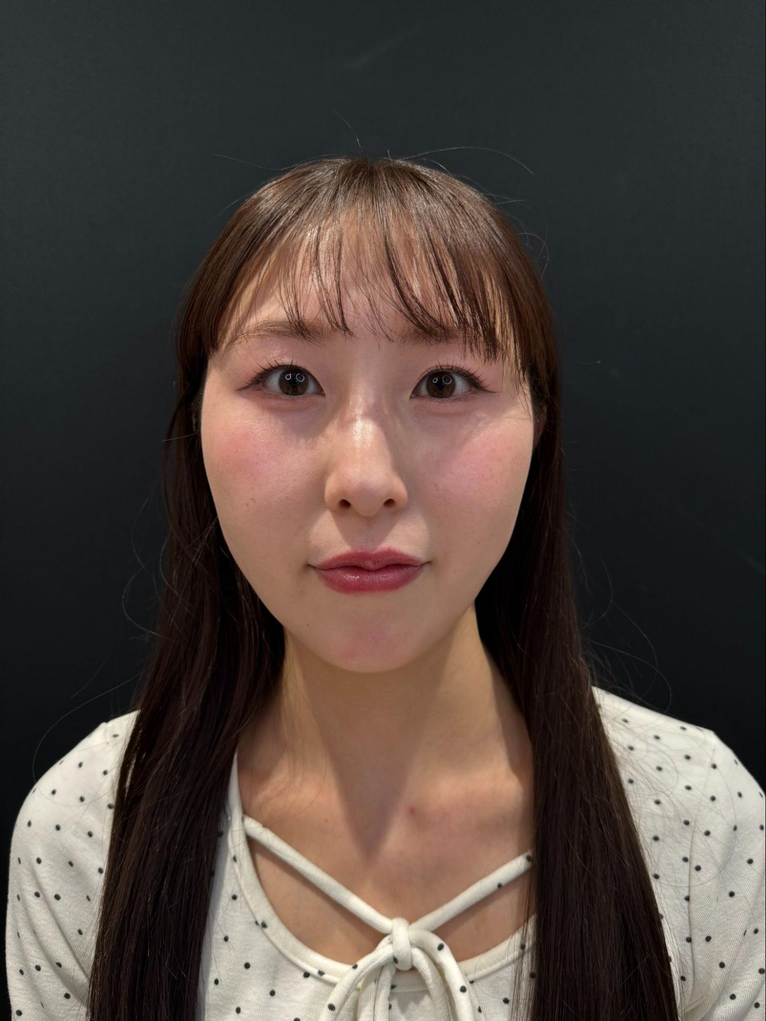 脂肪吸引注射(顔)の経過:術後1か月の症例写真と傷跡