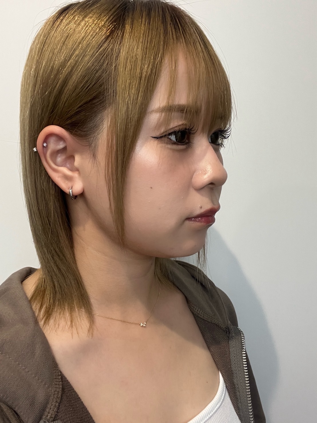 脂肪吸引注射(顔)の経過:施術後2週間の症例写真と傷跡