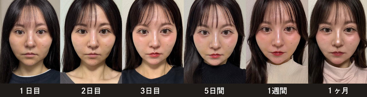 脂肪吸引注射(メーラーファット)のダウンタイム:メーラーファット:頬の腫れや硬さ、違和感が出ることがあり、組織の回復とともに馴染んでいく
