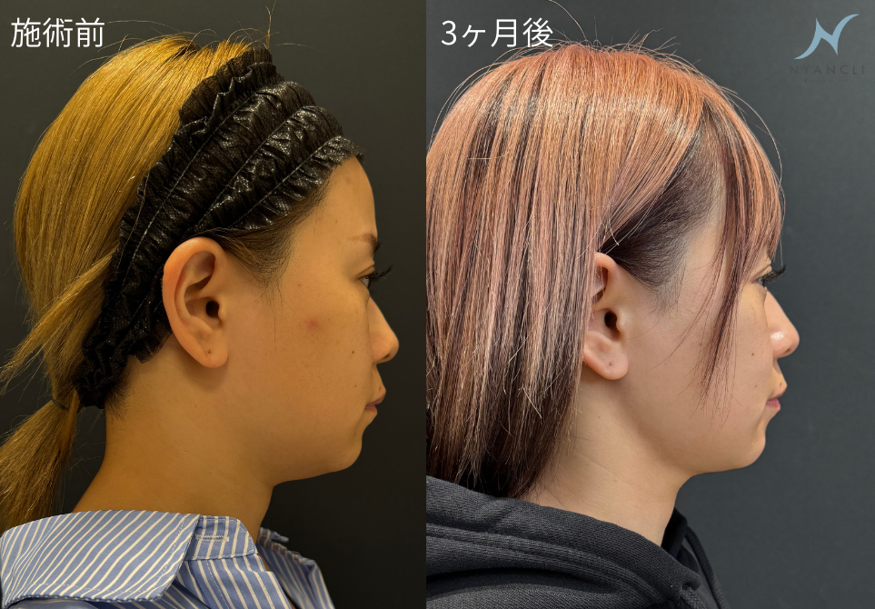脂肪吸引注射(あご下)の症例:施術前後の比較写真と傷跡