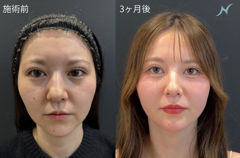 脂肪吸引注射(メーラーファット)の症例:施術前後の比較写真と傷跡