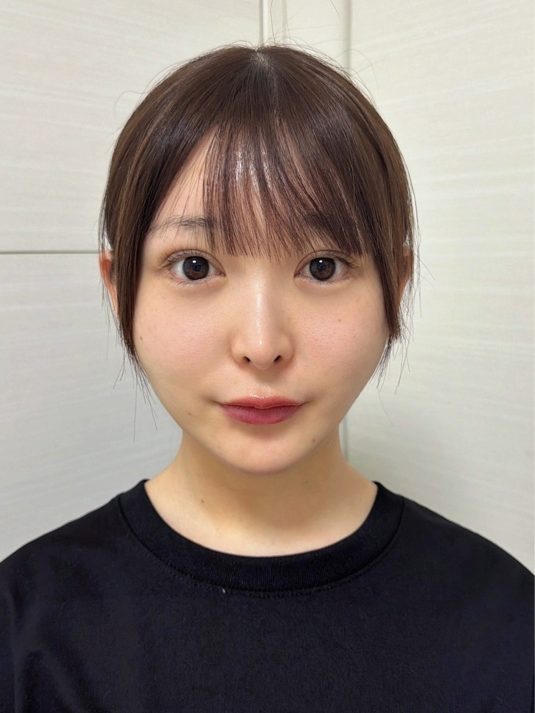 脂肪吸引注射(顔)の経過:施術直後の症例写真と傷跡