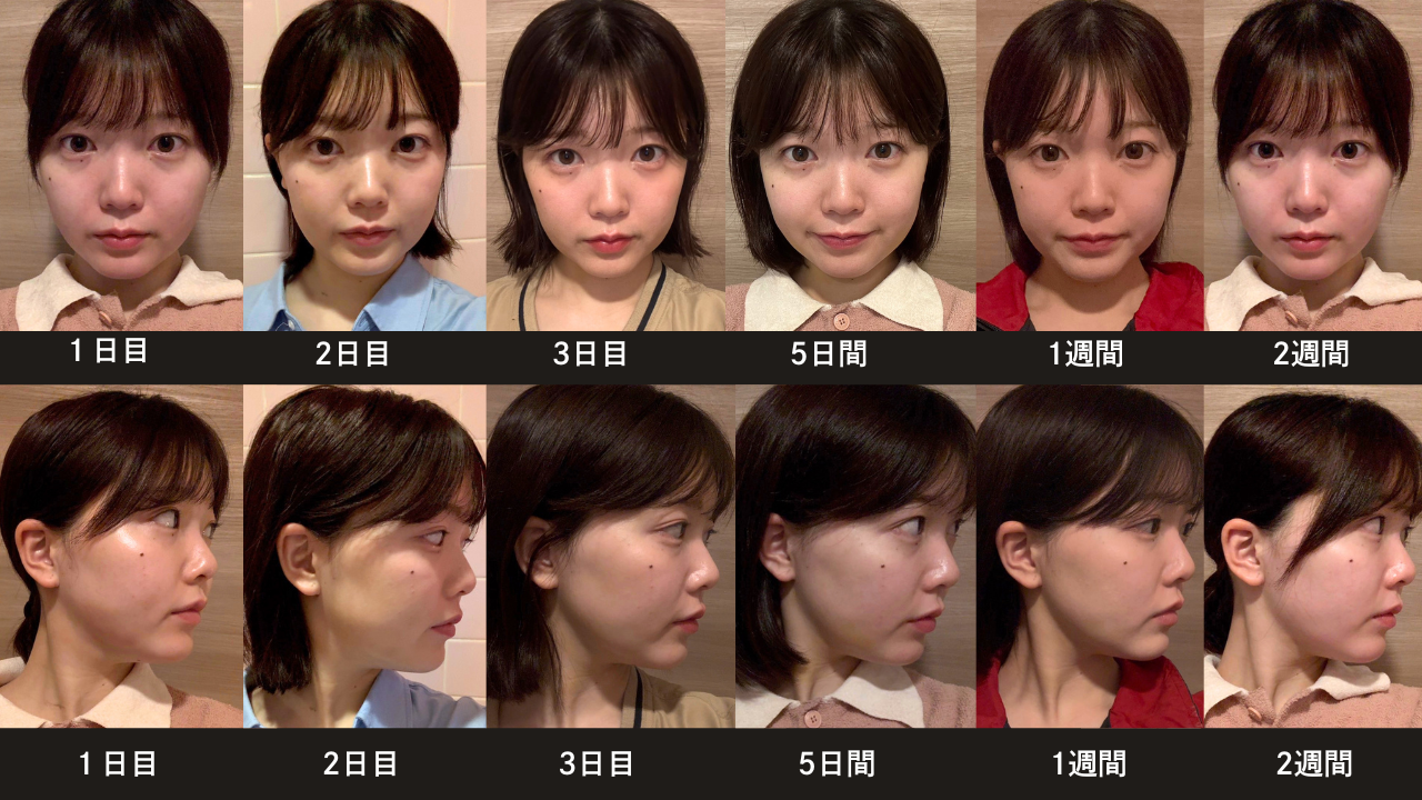 脂肪吸引注射(あご下)のダウンタイム:腫れやむくみによって二重あごのように見えることがある