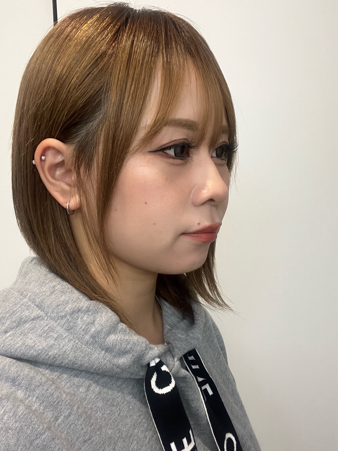 脂肪吸引注射(顔)の経過:施術後3か月の症例写真と傷跡