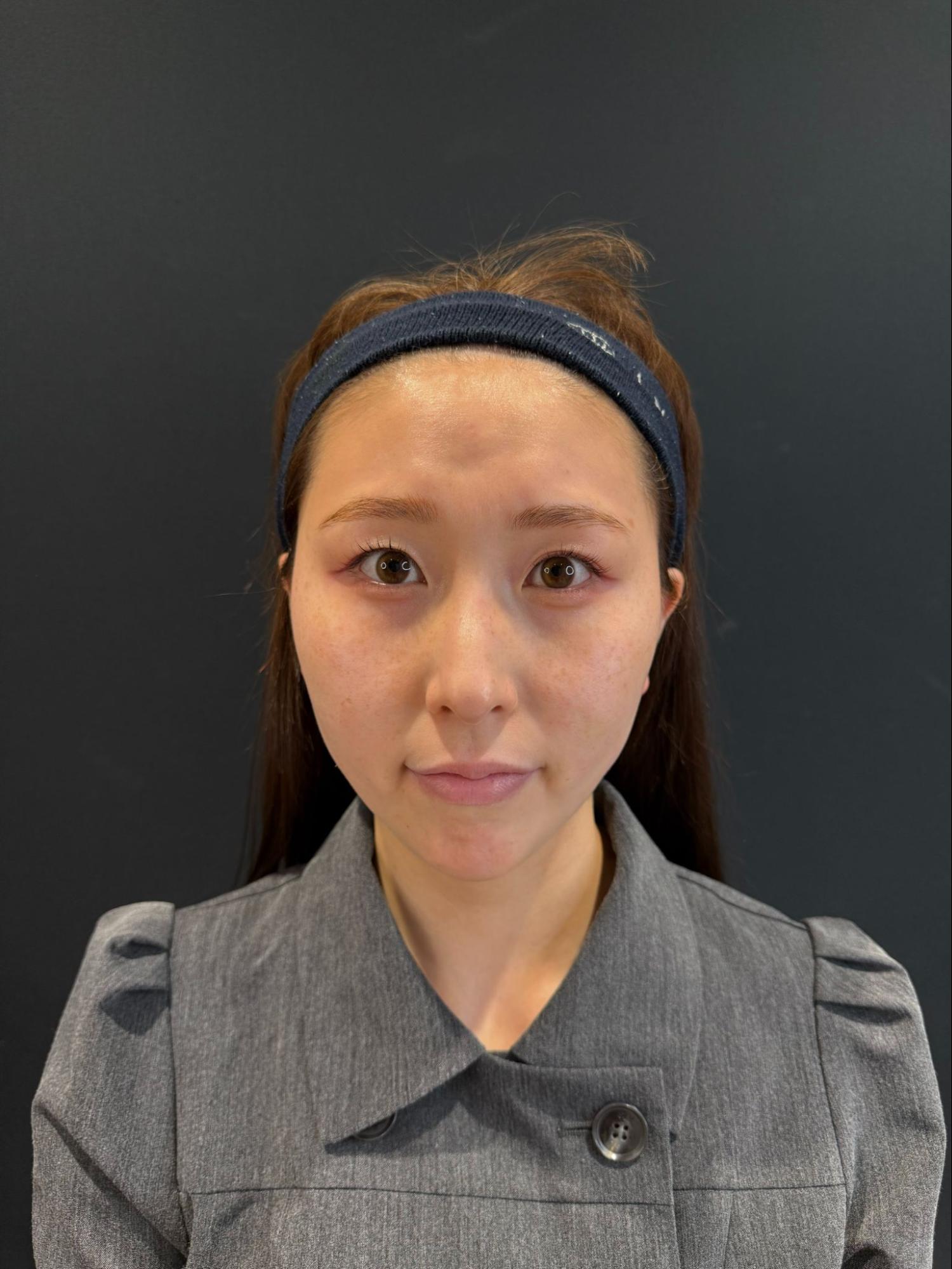 脂肪吸引注射(顔)の経過:術後6か月の症例写真と傷跡