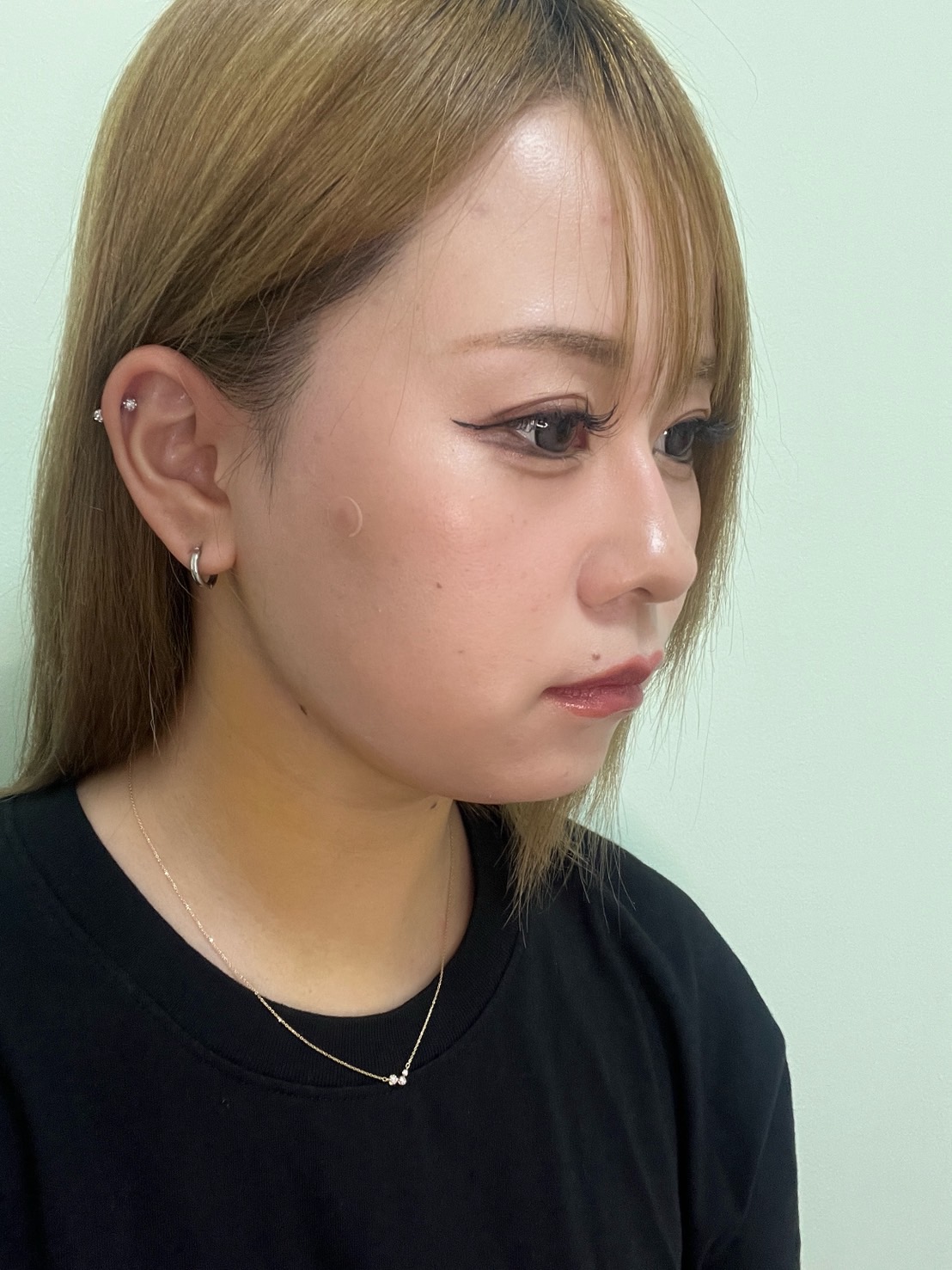 脂肪吸引注射(顔)の経過:施術後5日目の症例写真と傷跡