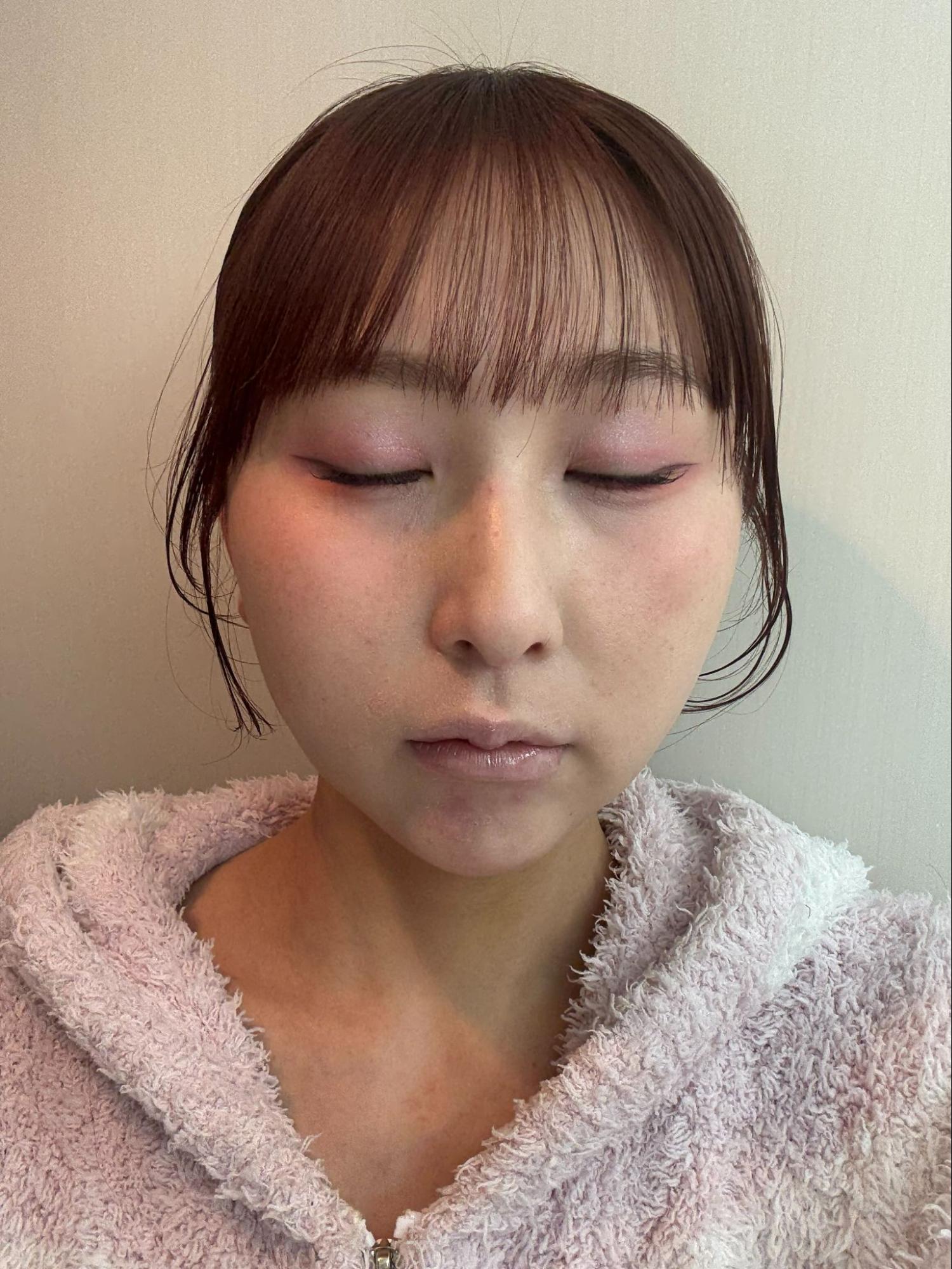 脂肪吸引注射(顔)の経過:術後1週間の症例写真と傷跡