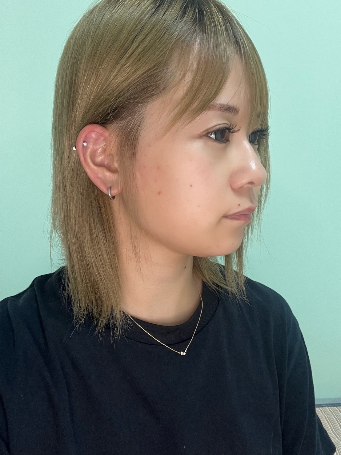 脂肪吸引注射(顔)の経過:施術後1週間の症例写真と傷跡