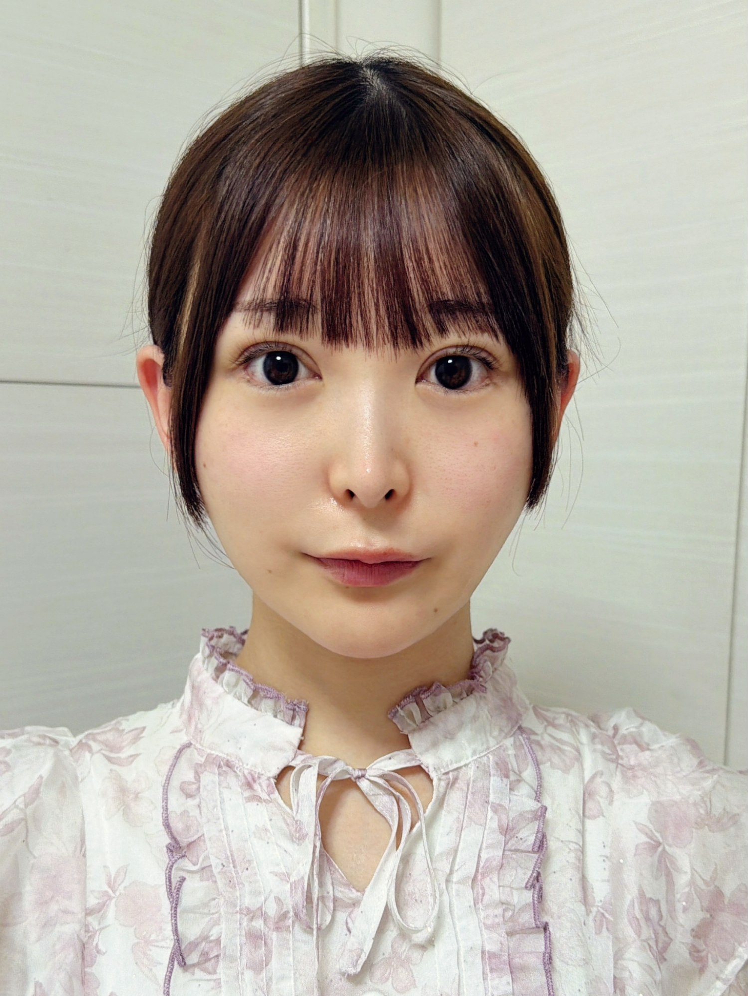 脂肪吸引注射(顔)の経過:術後1週間の症例写真と傷跡