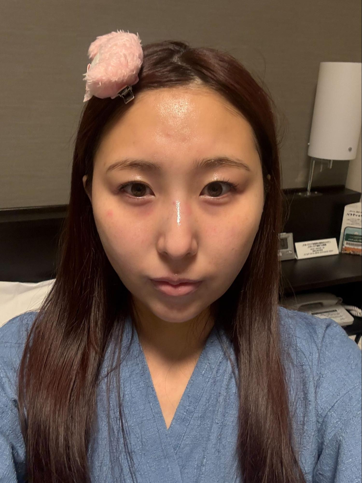 脂肪吸引注射(顔)の経過:術後3日目の症例写真と傷跡