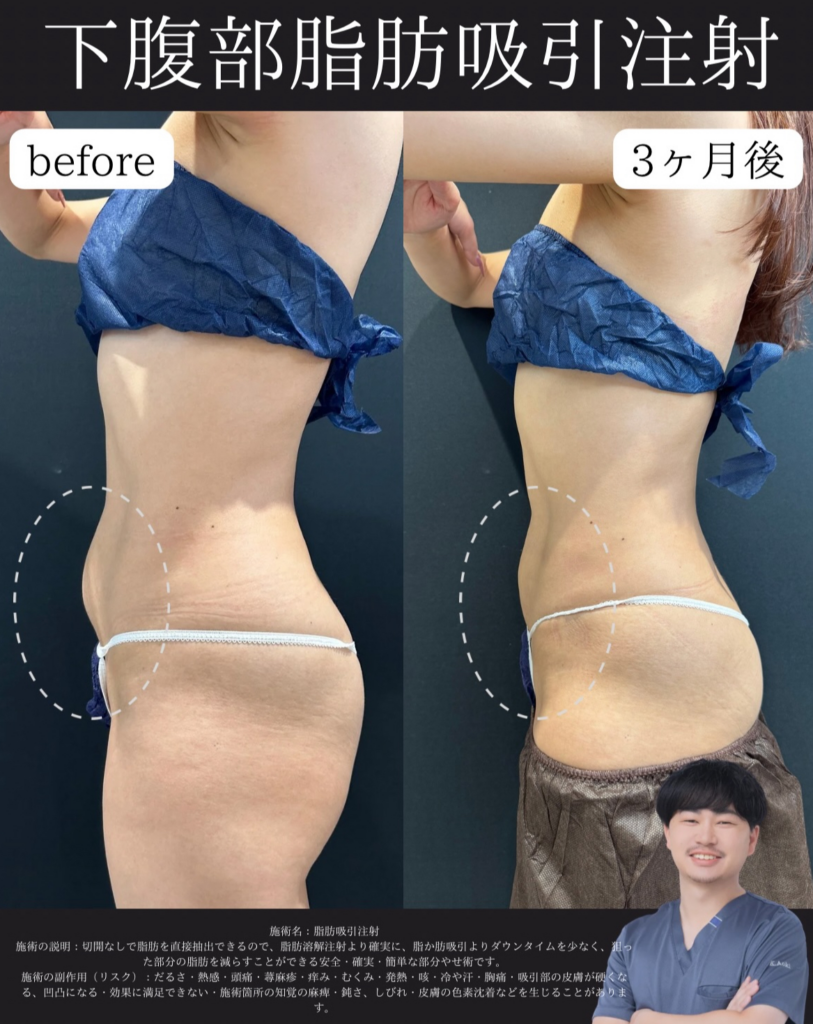 下腹部脂肪吸引注射症例