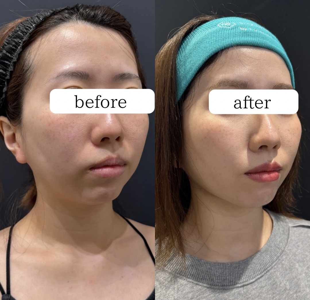 脂肪吸引注射(ジョールファット)の症例:施術前後の比較写真と傷跡