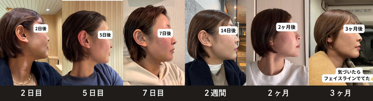 脂肪吸引注射(あご下)の症例:施術前後の比較写真と傷跡