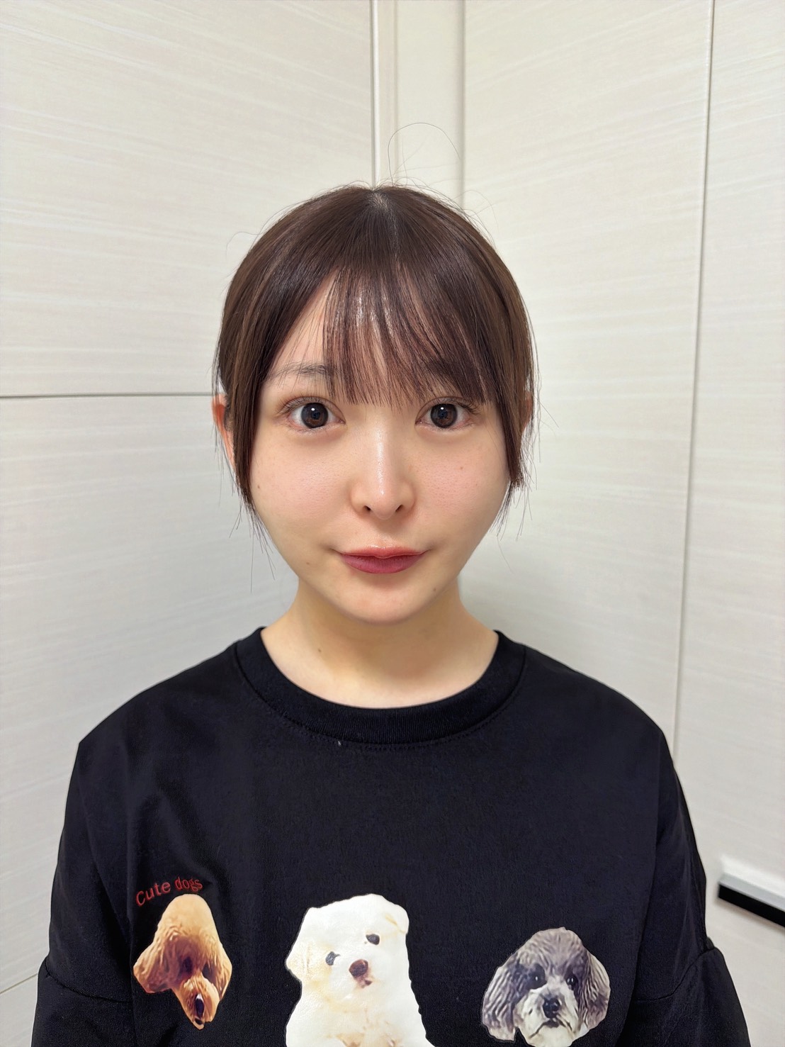 脂肪吸引注射(あご下)の経過:術後1日目の症例写真と傷跡