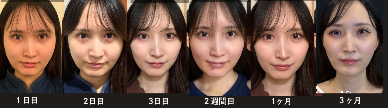 脂肪吸引注射(頬・ジョールファット)の症例:施術前後の比較写真と傷跡