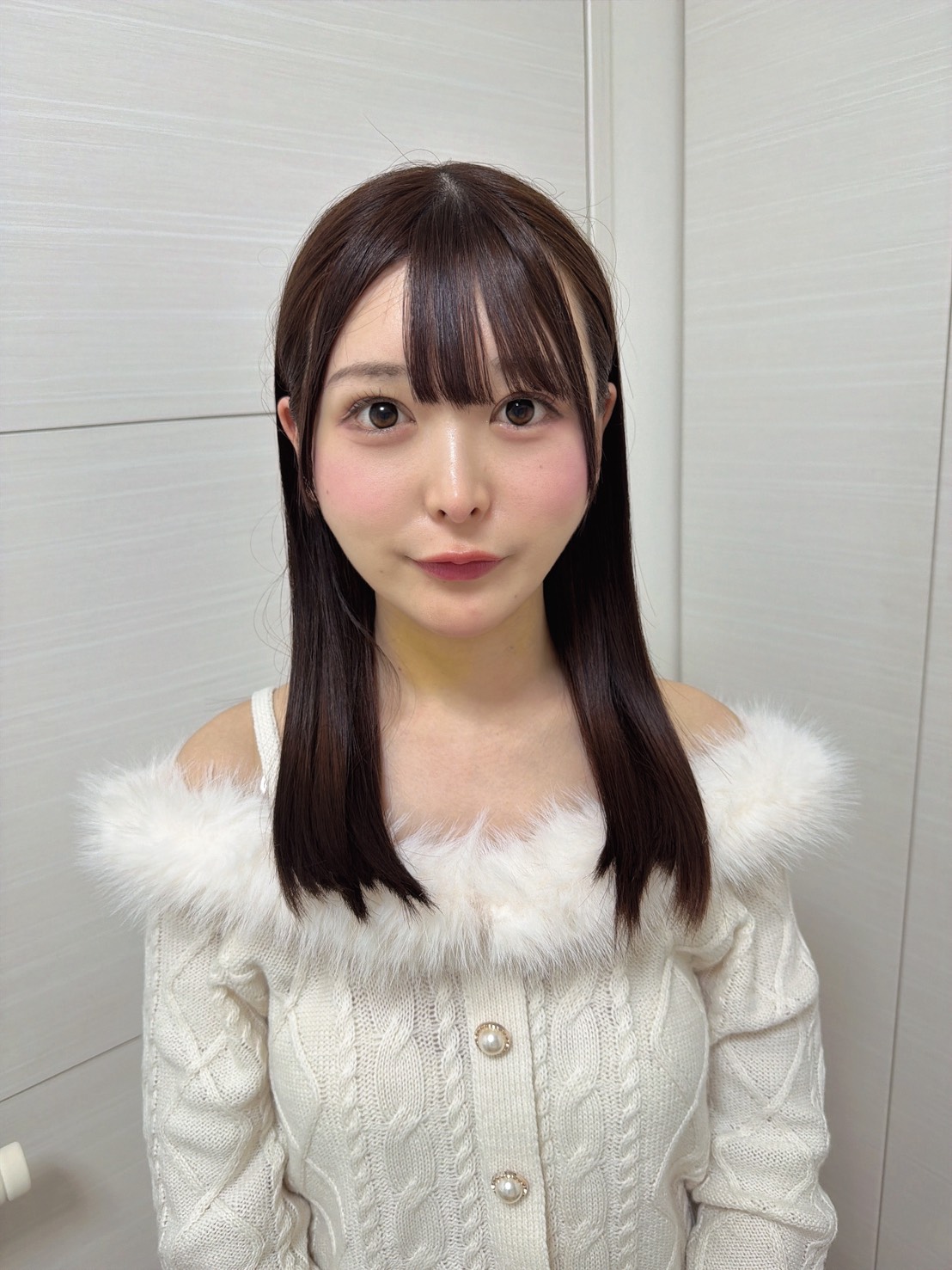 脂肪吸引注射(あご下)の経過:術後3日目の症例写真と傷跡