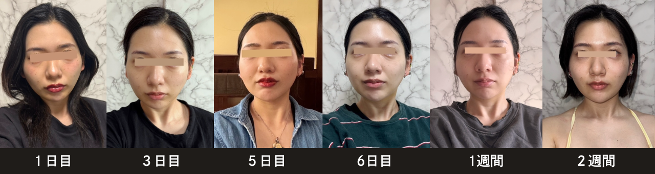 脂肪吸引注射(頬・フェイスライン)の症例:施術前後の比較写真と傷跡