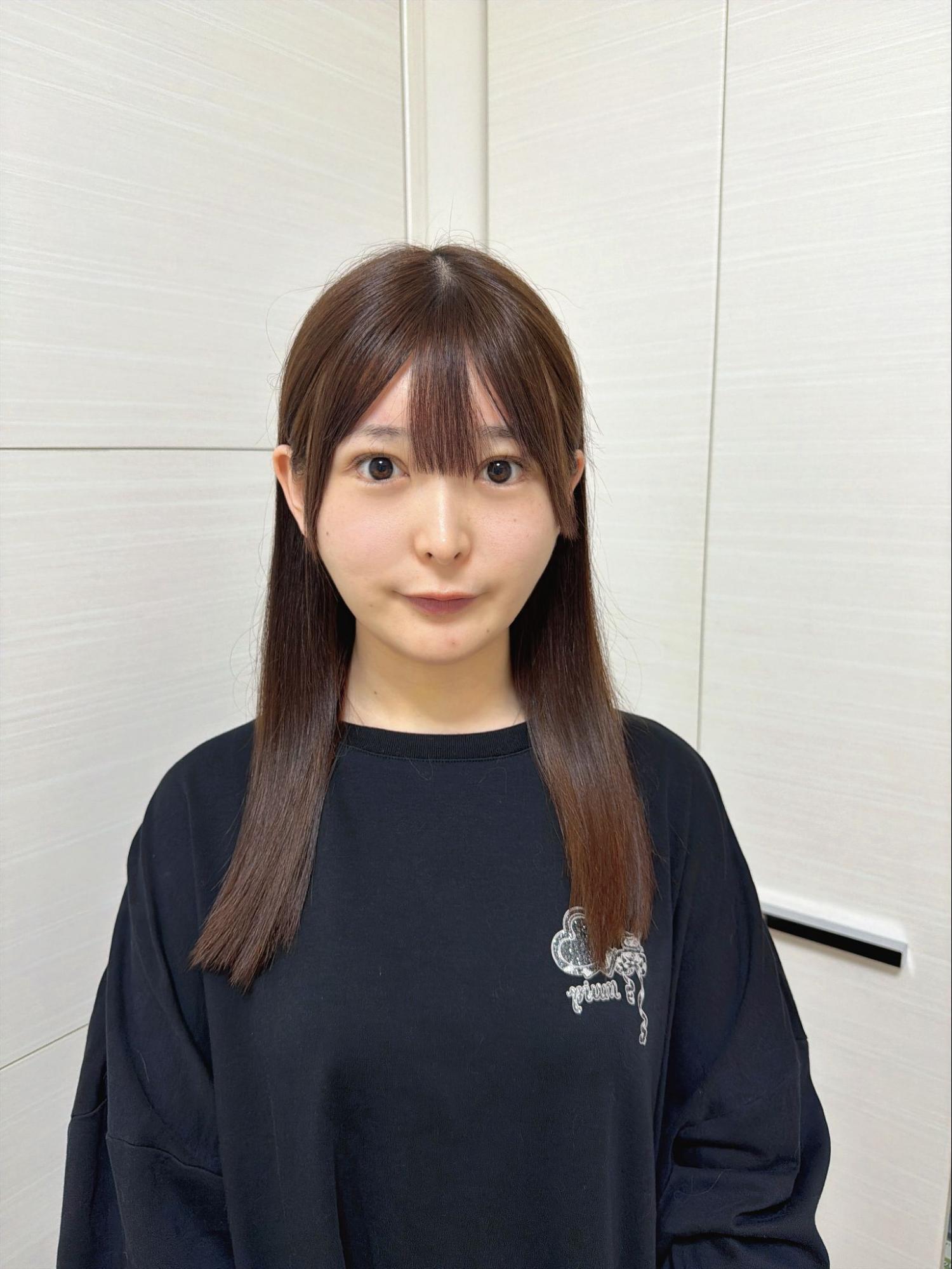 脂肪吸引注射(あご下)の経過:術後5日目の症例写真と傷跡